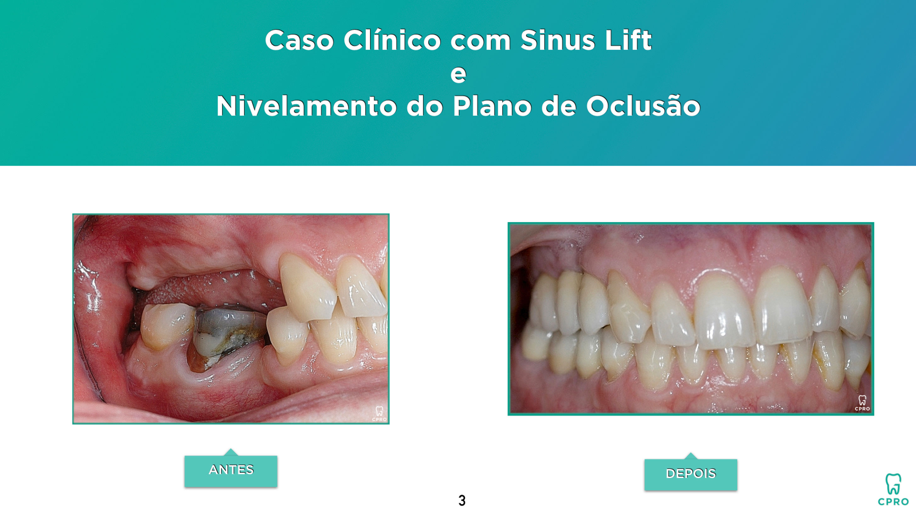 Caso Clínico com Sinus Lift e Nivelamento do Plano de Oclusão